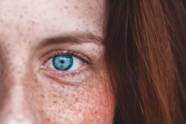 hyperpigmentation