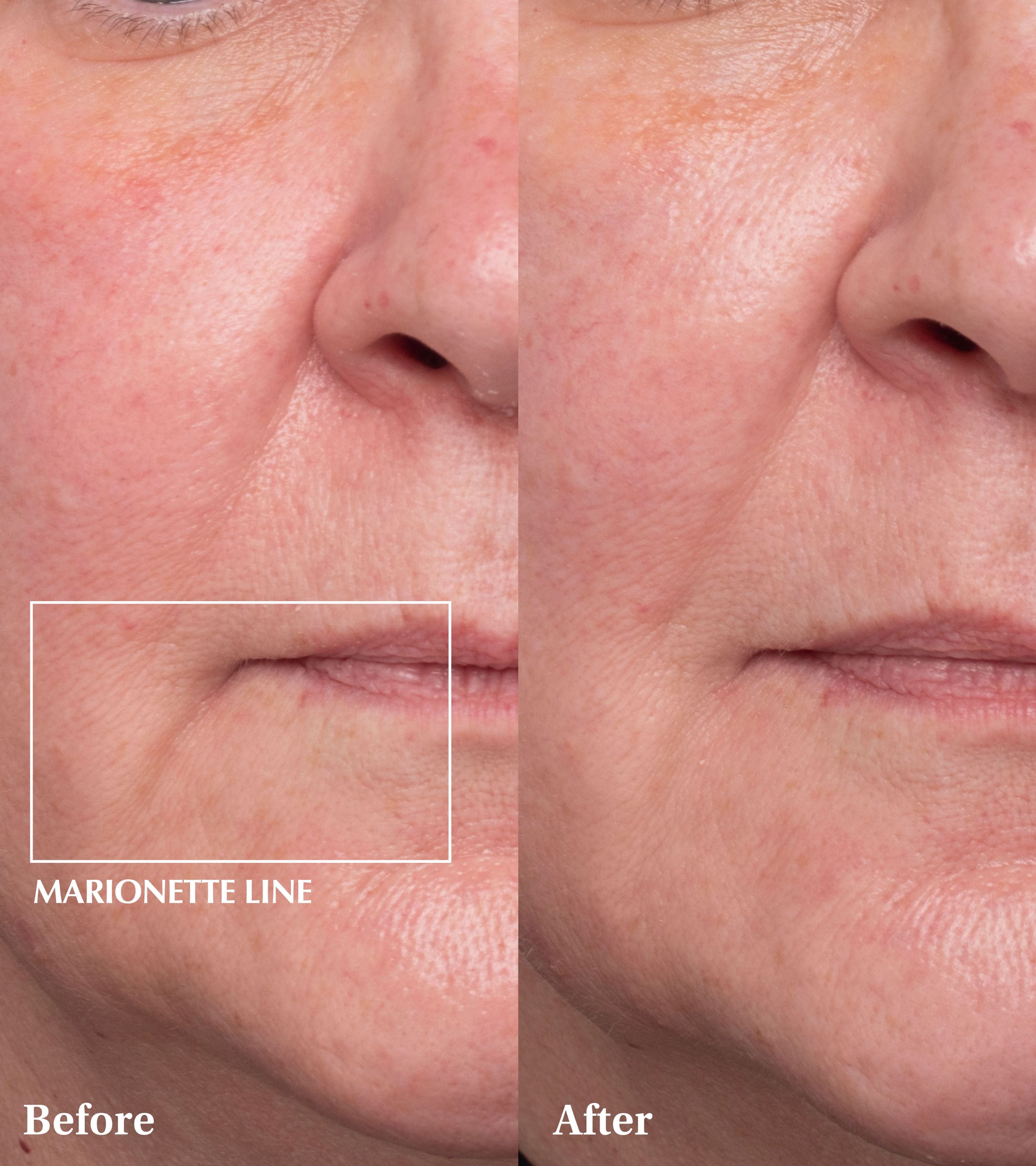 Spaoxy Gel (3 Masks)
